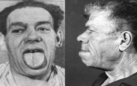 Что такое аденома гипофиза? Какие при аденоме гипофиза симптомы и лечение?
